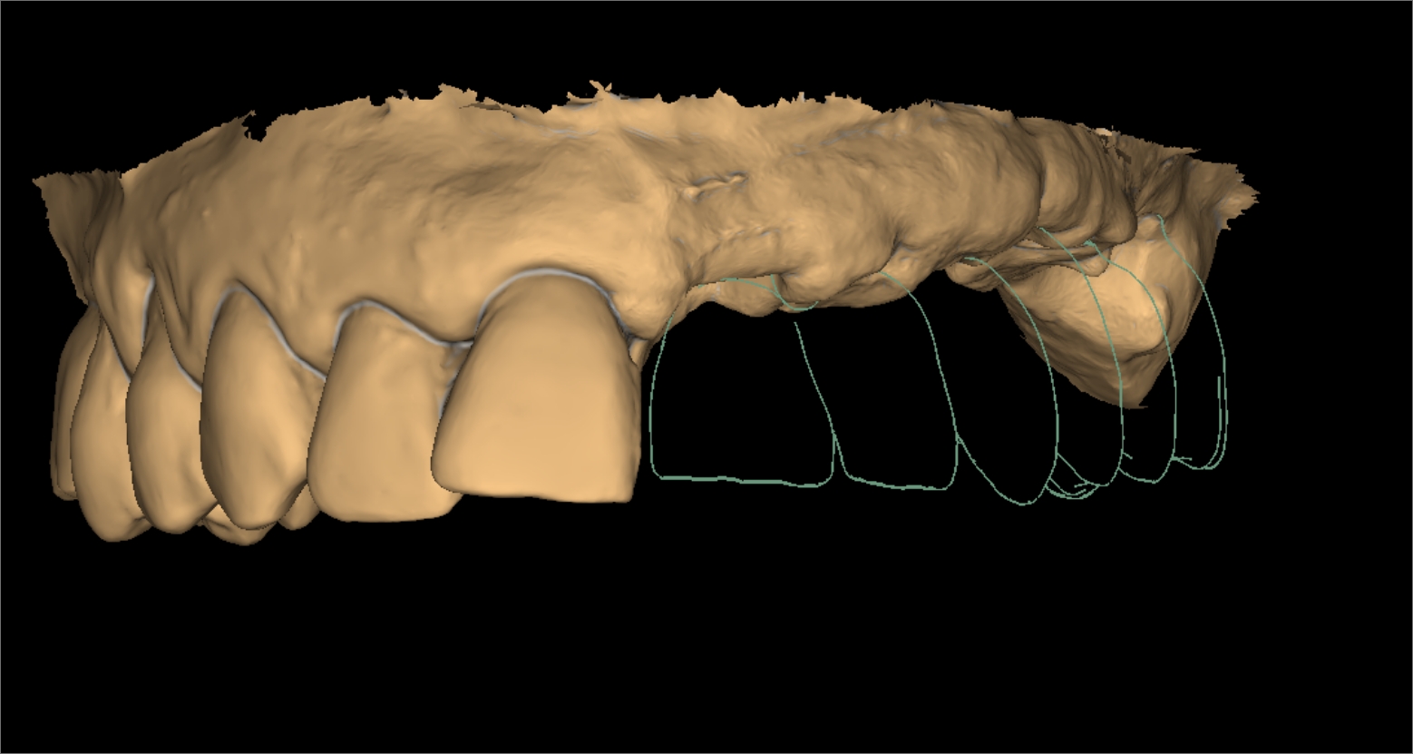 diseno-protesis-dentales-jaen-1