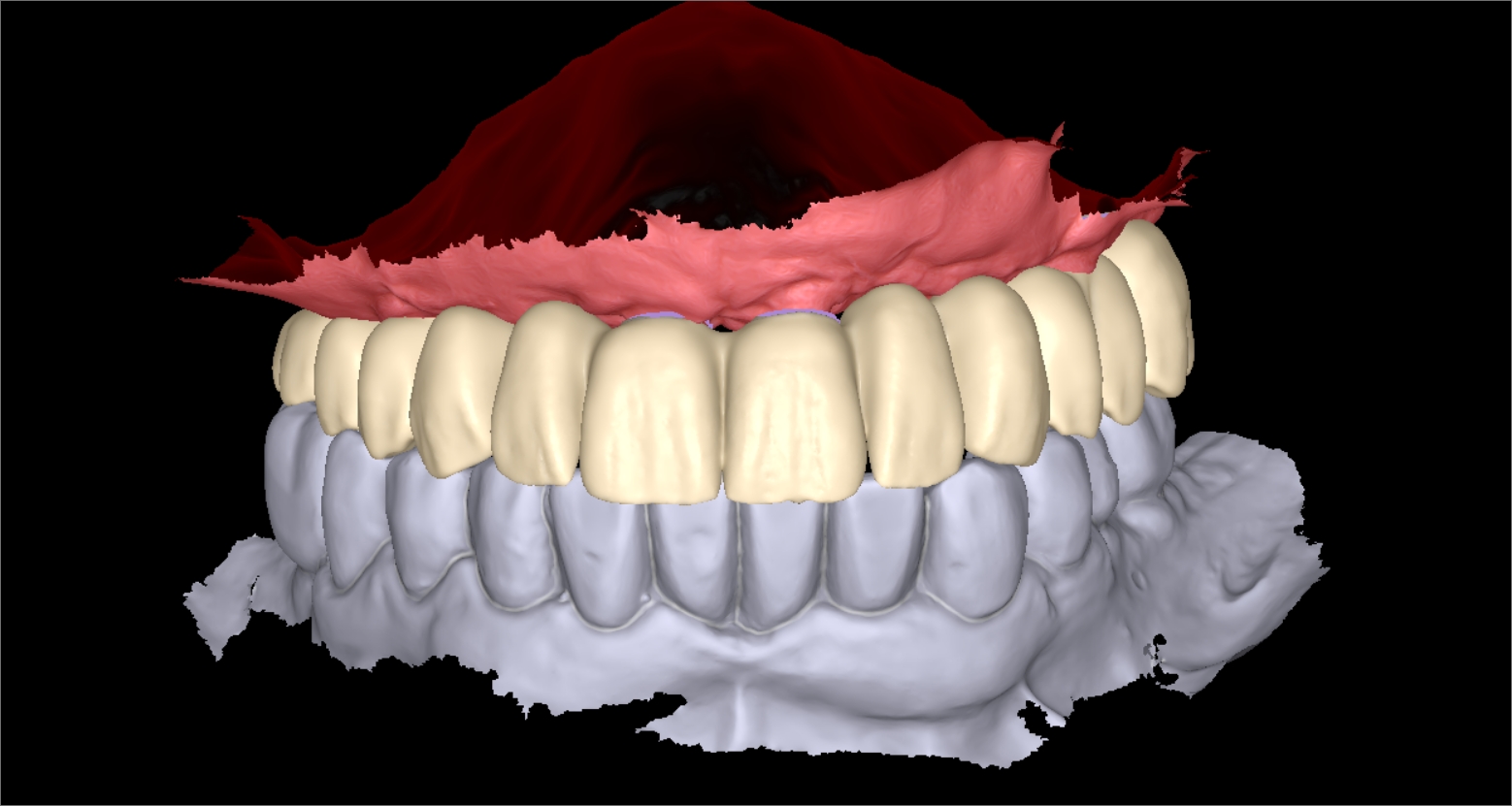 diseno-protesis-dentales-jaen-2
