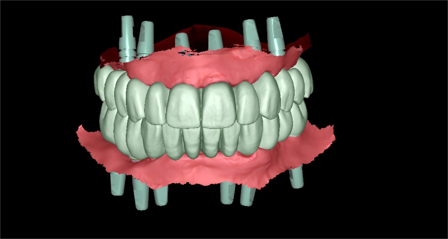diseno-protesis-dentales-jaen-4