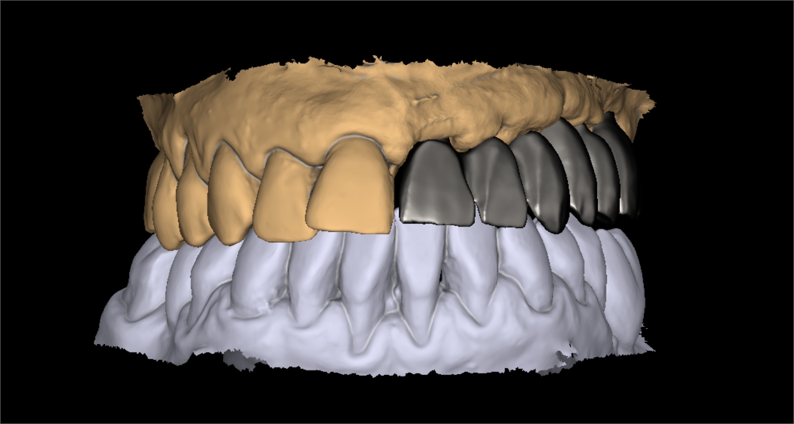 diseno-protesis-dentales-jaen-5