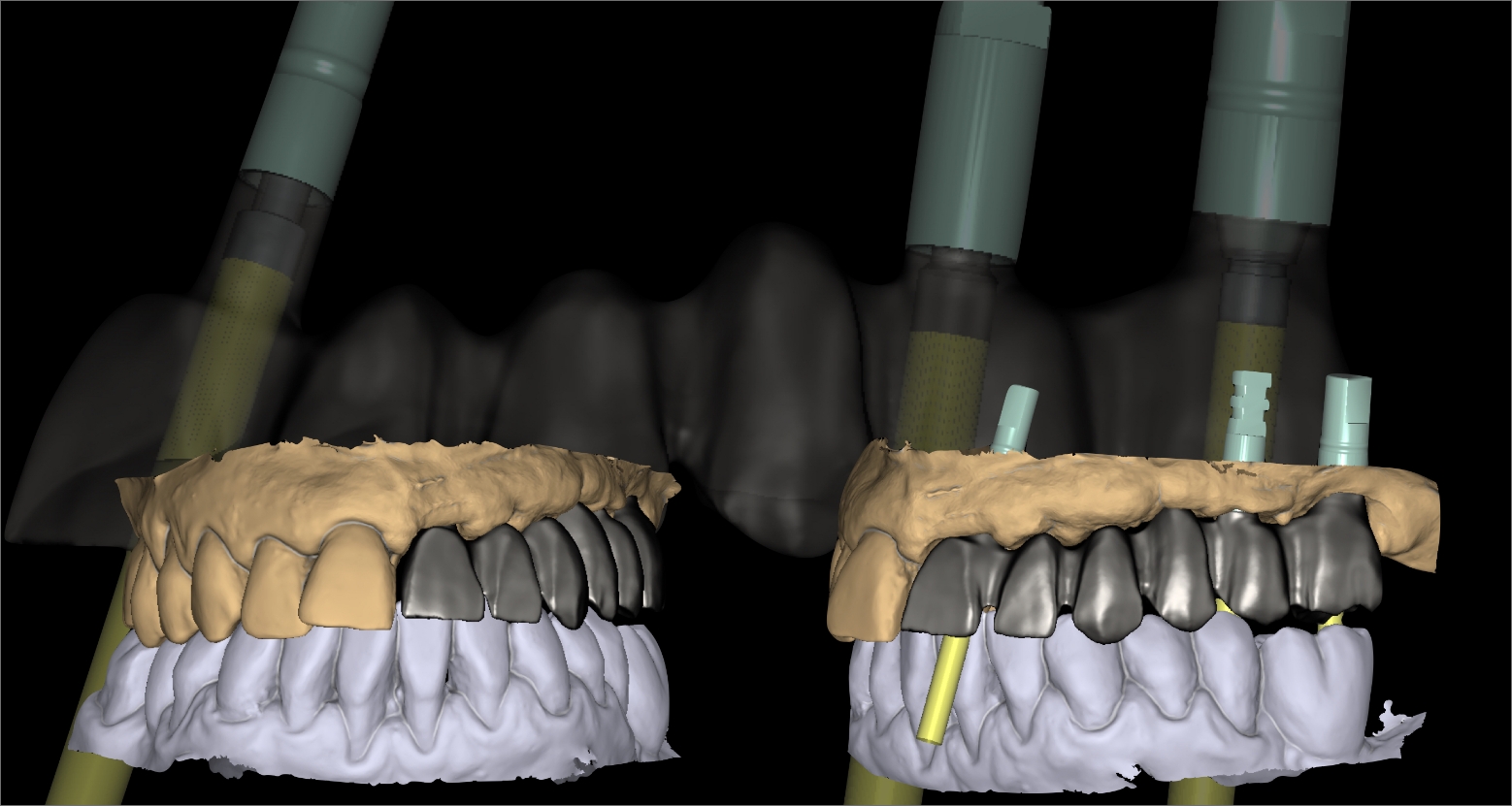 diseno-protesis-dentales-jaen-6